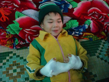 Nghịch pháo: Phải tháo hai đốt ngón tay - 1