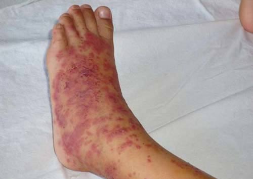 Đoàn đến đoàn về, bệnh “lạ” vẫn tăng - 2