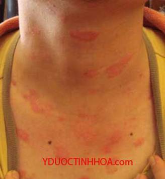 Điều trị và phòng tránh dị ứng như thế nào?, Sức khỏe đời sống, 