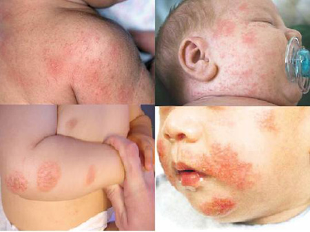 Cách phòng ngừa rôm sảy mùa hè cho trẻ, Sức khỏe đời sống,