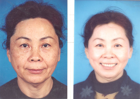 Hiệu quả trị nám, tàn nhang, đồi mồi trong đông y, Sức khỏe đời sống,