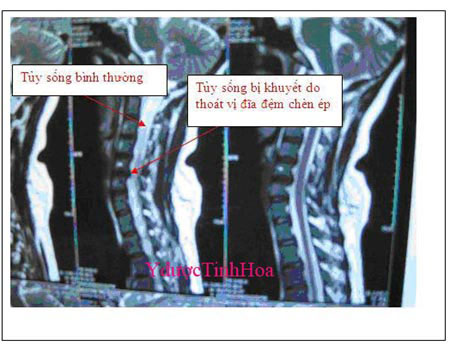 Điều trị đau vai gáy với Tinh Hoa dưỡng cốt - 2