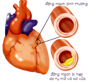 Đột quỵ, đau thắt ngực -  nỗi đau, gánh nặng, Sức khỏe đời sống, 