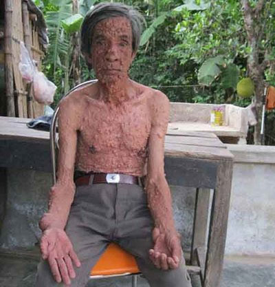Những người khốn khổ vì suốt đời "cõng" u - 2
