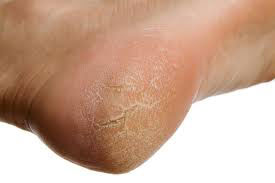 Nứt gót chân... Dưỡng da chân.