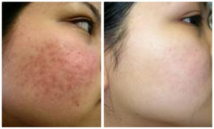 "Siêu bí kíp" đánh bay mụn trứng cá cực kỳ đơn giản - 2