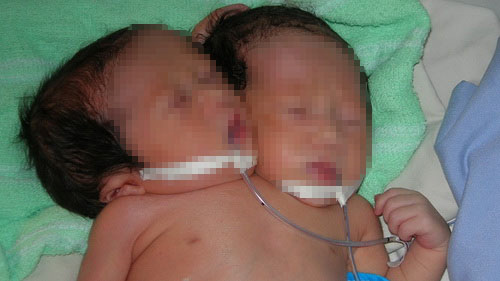 Bé gái có hai đầu ở Sóc Trăng - 1