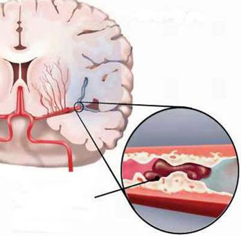 Phòng & điều trị thiếu mãu não - 1