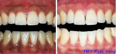 Nướu răng thâm đen - phương pháp nào điều trị? - 3