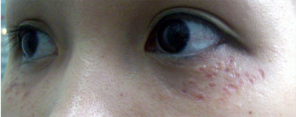 Không thể coi thường biến chứng nguy hiểm của Mụn thịt quanh mắt (U tuyến mồ hôi) đối với nền da mặt, Làm đẹp, 
