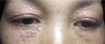 Không thể coi thường biến chứng nguy hiểm của Mụn thịt quanh mắt (U tuyến mồ hôi) đối với nền da mặt, Làm đẹp, 