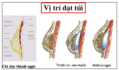 Nâng ngực bằng chất liệu gel giọt nước hai lõi, bảo hành trọn đời, Làm đẹp, 