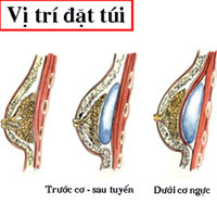 Nâng ngực bằng chất liệu gel giọt nước hai lõi, bảo hành trọn đời