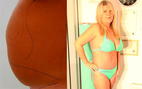 Làm đẹp - Người phụ nữ tự tin hơn nhờ hút 2 lít mỡ khỏi bụng