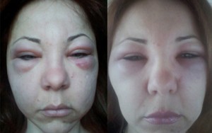 Làm đẹp - Nữ luật sư mặt sưng như quả bóng sau khi tiêm căng da