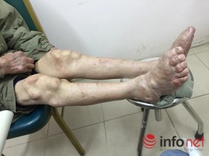 Sức khỏe đời sống - Suy thận vì điều trị gout ở phòng khám đông y Trung Quốc