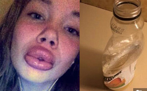 Bí quyết làm đẹp - 2 cô gái mồm sưng vều vì bơm môi bằng chai nước