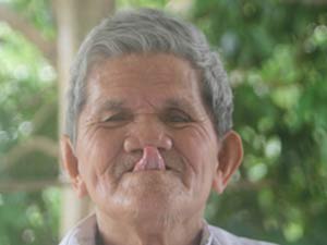 Tin tức trong ngày - Khỏi câm điếc, cụ ông có khả năng đưa lưỡi tới mũi