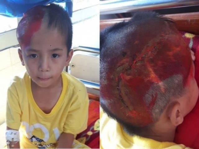 Bạn trẻ - Cuộc sống - Xót xa bé trai 8 tuổi vật vã đau đớn vì ghép não