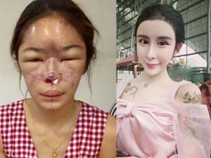 Làm đẹp - 5 mỹ nam, mỹ nữ bị hỏng mặt vì ham phẫu thuật thẩm mỹ