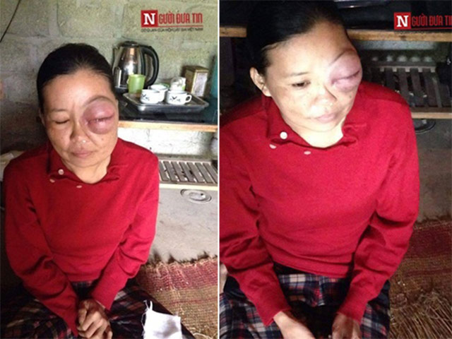 Bạn trẻ - Cuộc sống - Bi kịch cuộc đời người phụ nữ mắt như gấu trúc