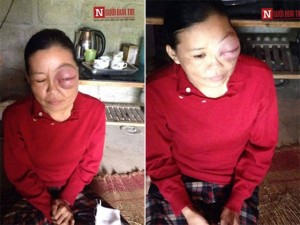 Bạn trẻ - Cuộc sống - Bi kịch cuộc đời người phụ nữ mắt như gấu trúc