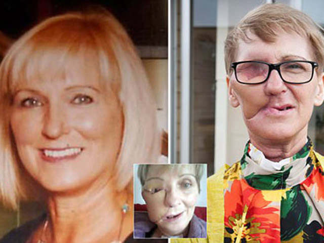 Bạn trẻ - Cuộc sống - Người phụ nữ dũng cảm công khai gương mặt "méo mó" vì ung thư