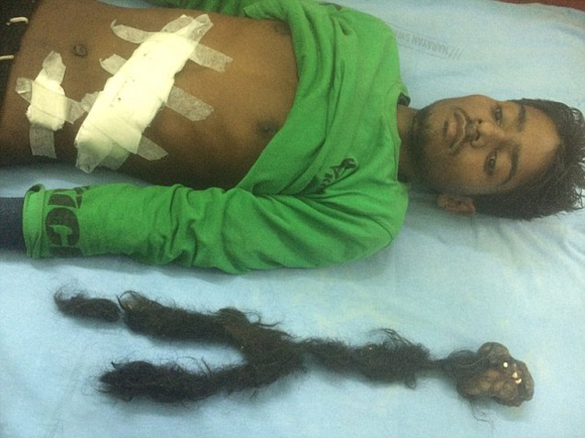 Bạn trẻ - Cuộc sống - Kinh hoàng chàng trai "mang thai" ký sinh trùng 2.5kg