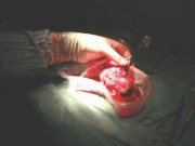 Thâm nhập đường dây đưa người sang TQ bán thận (P.1)