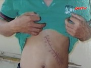 Thâm nhập đường dây đưa người sang TQ bán thận (P.2)