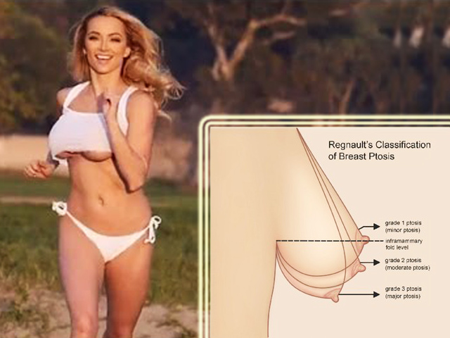 Làm đẹp - Tác hại không tưởng từ thói quen 'thả rông' vòng một