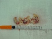 Suýt mất lỗ mũi vì silicon hóa thạch