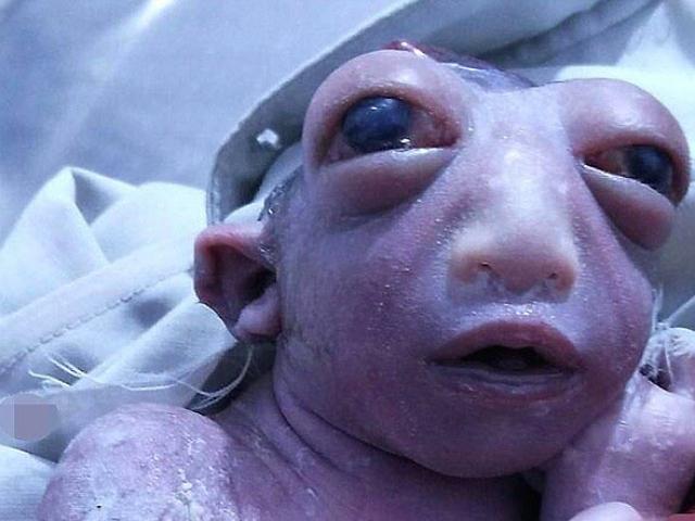 Phi thường - kỳ quặc - Em bé chỉ có nửa đầu chào đời tại Ấn Độ