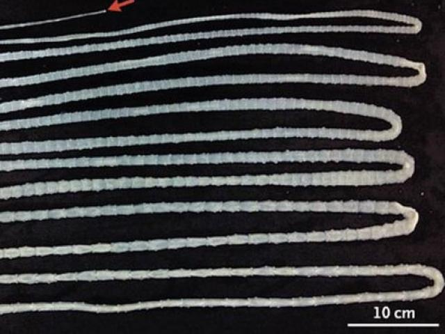 Sức khỏe đời sống - "Nuôi" sán dài 6 mét nhiều năm trời vì thói quen ăn thịt bò tái