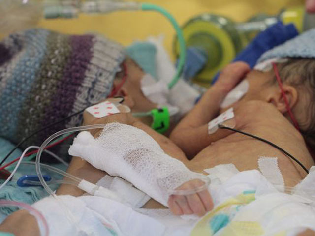 Sức khỏe đời sống - Phẫu thuật tách thành công cặp đôi song sinh dính liền ít tuổi nhất