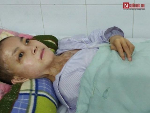 Giới trẻ - Xót xa cậu bé bị điện giật cháy đen toàn thân ngày giáp Tết