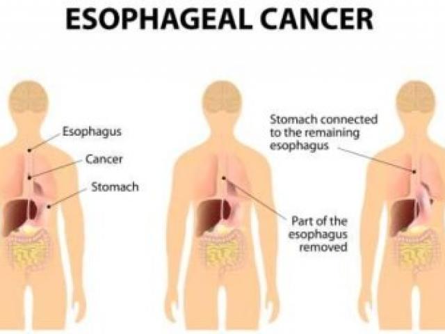Sức khỏe đời sống - Bệnh nướu răng có thể dẫn đến ung thư thực quản