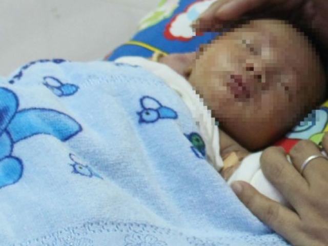 Sức khỏe đời sống - Bé sơ sinh mắc dị tật hiếm gặp ở ruột