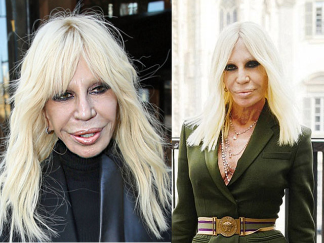 Làm đẹp - Chết khiếp vì gương mặt biến dạng của đại gia làng mốt