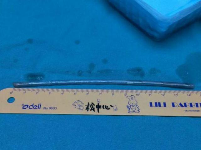 Thế giới - TQ: Bực vợ, chồng nuốt chửng đinh dài 15cm