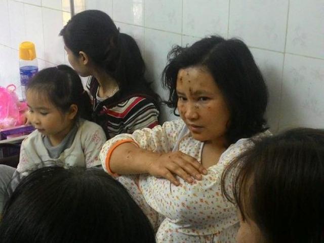 Nạn nhân kể lại giây phút nổ kinh hoàng ở KĐT Văn Phú