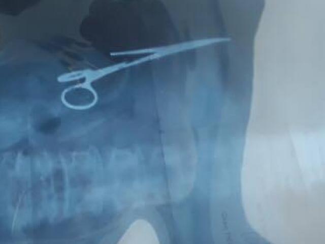 Sức khỏe đời sống - Phẫu thuật lấy chiếc kéo trong bụng bệnh nhân 18 năm