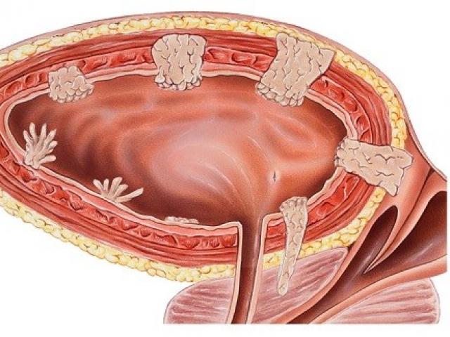 Những người có khối u ở vị trí này, 90% sẽ mắc ung thư