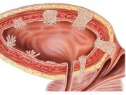 Sức khỏe đời sống - Những người có khối u ở vị trí này, 90% sẽ mắc ung thư