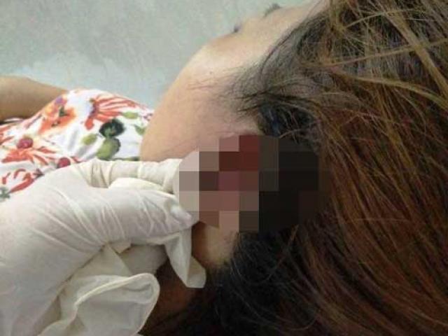 Tin tức trong ngày - Làm đẹp đón Tết, hai phụ nữ mất tai, tróc da đầu