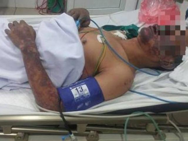 Tin tức trong ngày - Người đàn ông hoại tử toàn thân sau khi chế biến “lợn cắp nách"