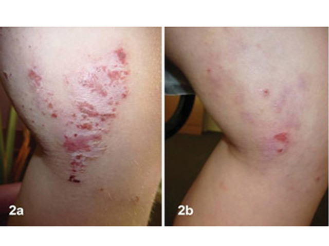 Tin tức sức khỏe - Chữa viêm da dị ứng ở trẻ bằng thảo dược