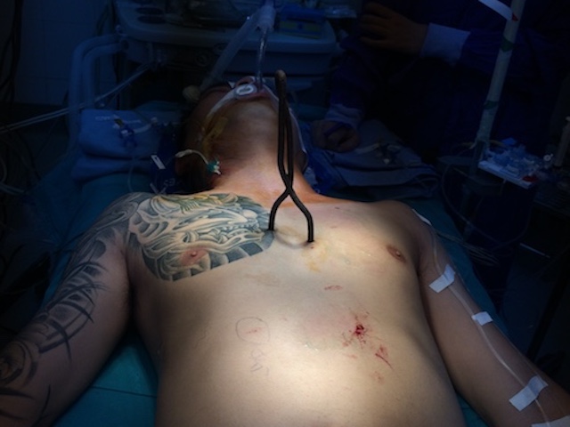 Sức khỏe đời sống - Hy hữu: Thanh sắt xiên cá đâm thủng 6 lỗ trên tim, vẫn sống