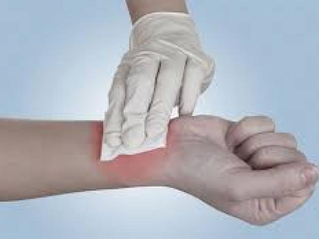 Sức khỏe đời sống - Mẹo hay dễ làm: Mẹo cầm máu vết thương