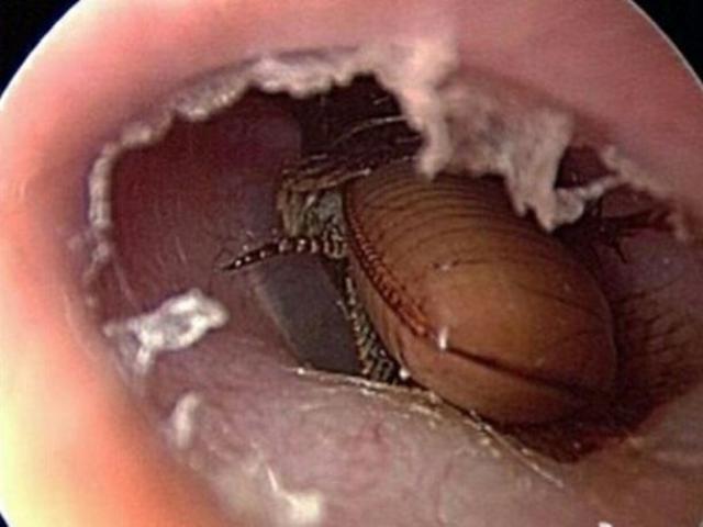 Phi thường - kỳ quặc - Tự xịt thuốc diệt côn trùng vào lỗ tai để giết gián
